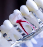 טיפול שורש 3 תעלות - תמונת אווירה